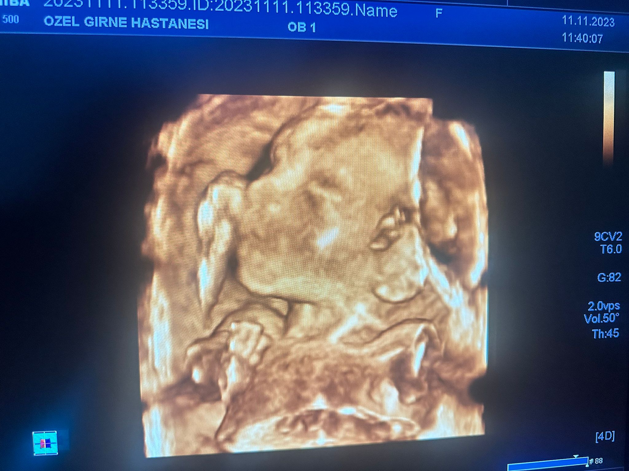 Kıbrıs Tüp Bebek Merkezi başarı hikâyesi bebek fotoğrafı 31 — galeri fotoğrafı